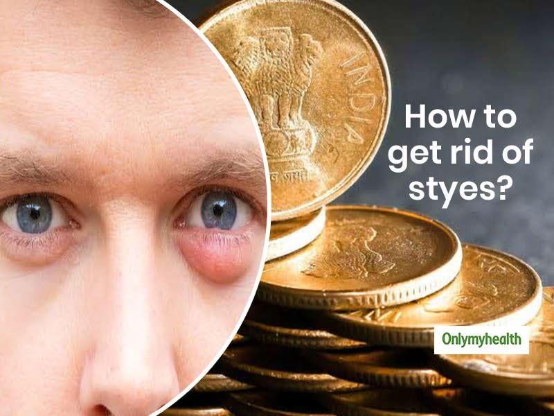 10 Natural Stye Treatments for Fast Relief