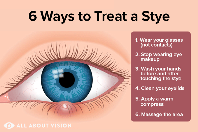 Stye in your eye? Top tips to get rid of it - The Eye Practice