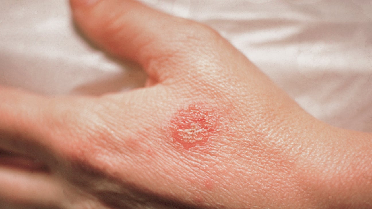 Nummular Dermatitis (Eczema) : Dermatology and Skin Surgery Center - North Carolina