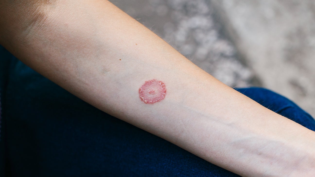 RED RASHES ON THE SKIN? READ THIS INFORMATIVE DEEP-DIVE | Mya Care